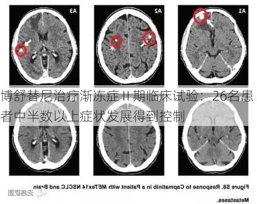 博舒替尼治疗渐冻症Ⅱ期临床试验：26名患者中半数以上症状发展得到控制